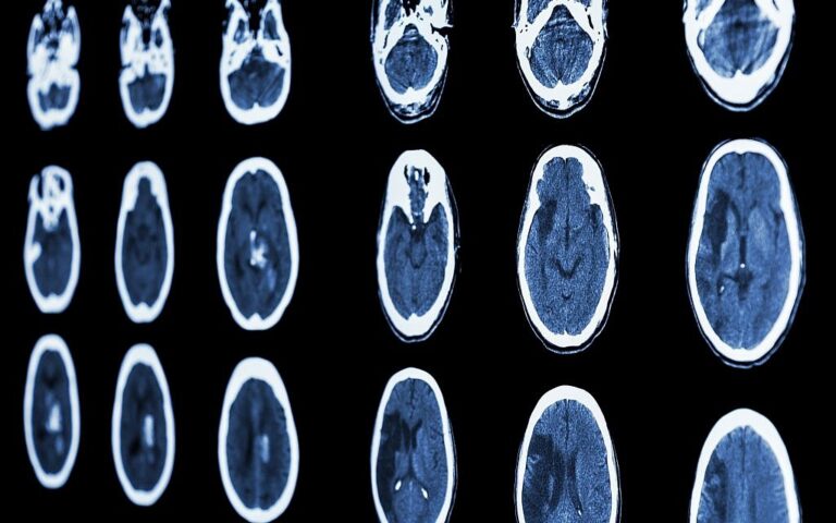 La startup israélienne Viz.ai décroche 100 millions de dollars pour une technologie d'IA qui détecte les conditions cérébrales dans les scans