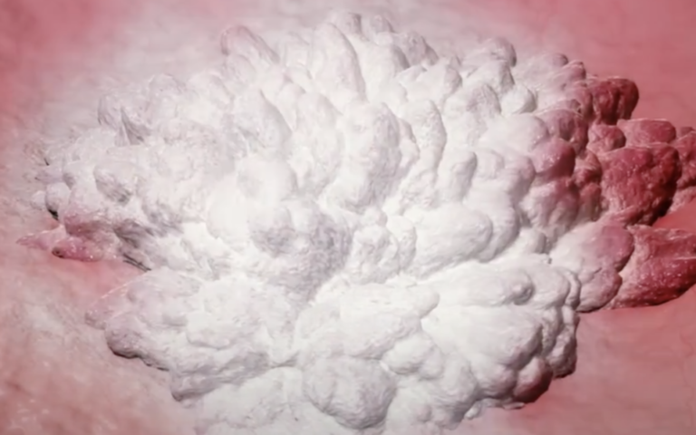 Geler la tumeur au lieu de la couper, les Israéliens lancent une nouvelle approche contre le cancer de la vessie