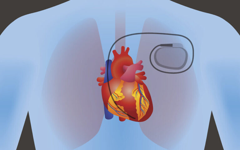 La nanotechnologie israélienne pourrait utiliser l'énergie du corps pour générer de l'énergie pour les stimulateurs cardiaques et plus
