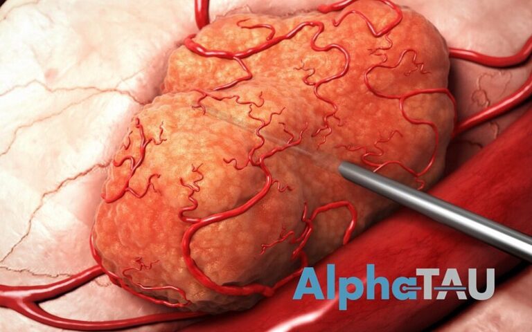 Alpha Tau Medical va fusionner avec SPAC à une valorisation de 1 milliard de dollars pour lutter contre le cancer